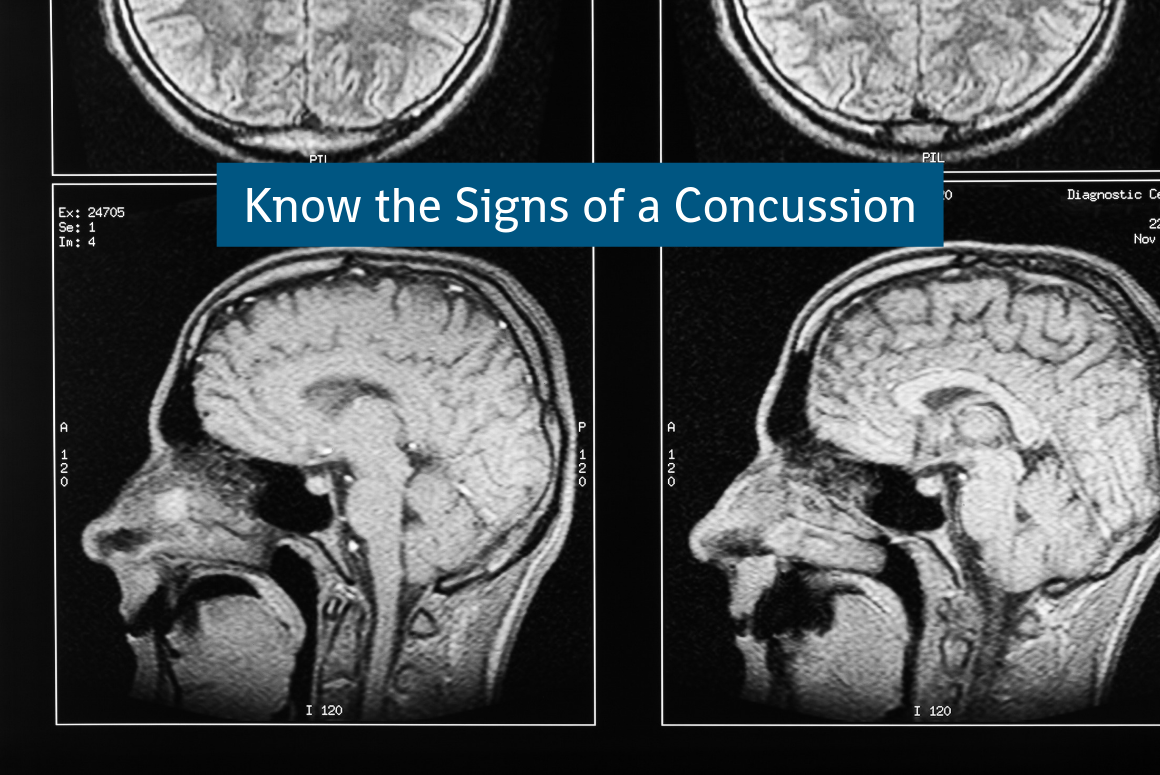 Prevent Summer Injuries - Know The Signs Of A Concussion